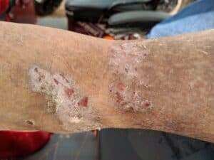 Scabies from Nursing Home